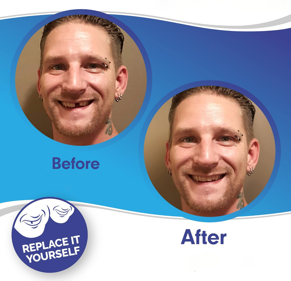 Clip-On Smile Veneers - Upper & Lower Set